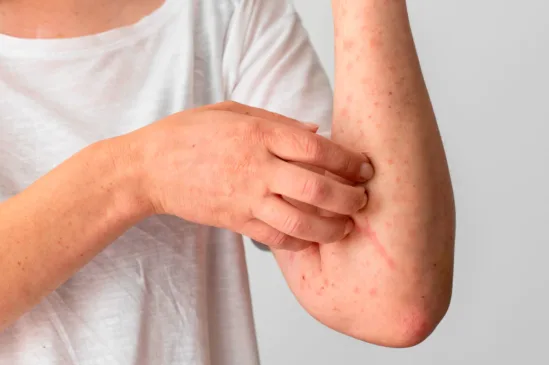 Manchas vermelhas no corpo (exantema) e febre são sinal de alerta para o sarampo. Crédito: Banco de imagens / Divulgação