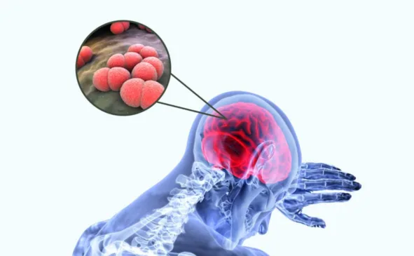 Representação de um quadro de meningite. Crédito: reprodução